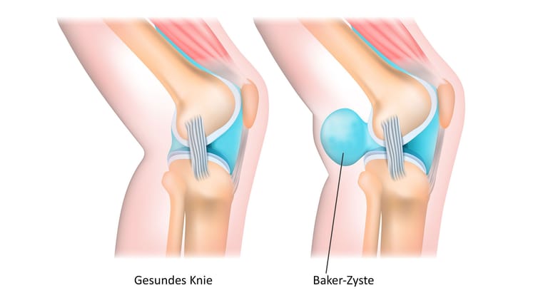 Baker Zyste Geplatzt Welche Symptome Auftreten Und Was Zu Tun Ist