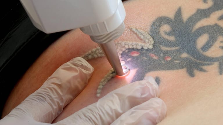 Tattooentfernung: In den Händen eines Arztes oder eines Spezialisten können Sie sich Ihr Tattoo weglasern lassen.