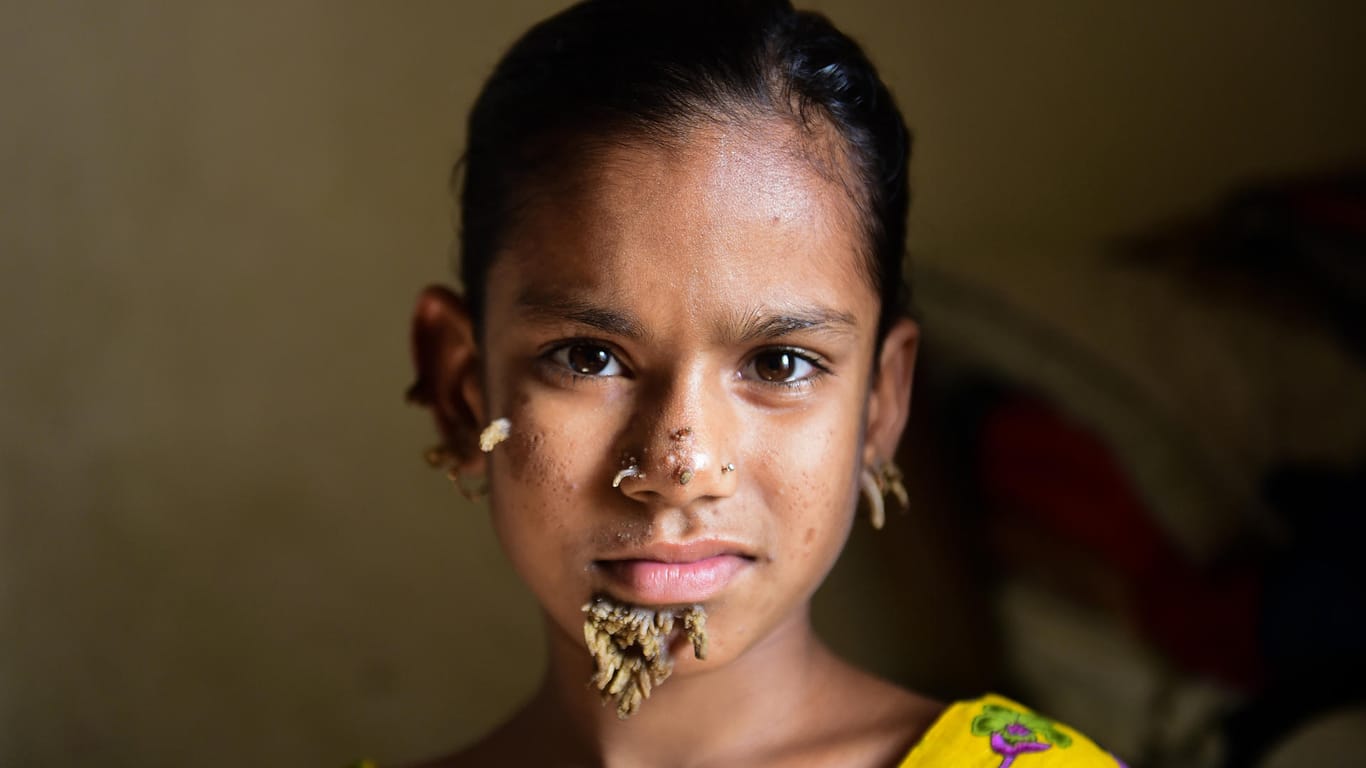Das "Baummädchen" Sahana Khatun (10) wurde erfolgreich operiert.