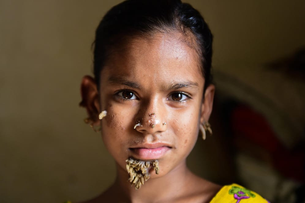 Das "Baummädchen" Sahana Khatun (10) wurde erfolgreich operiert.