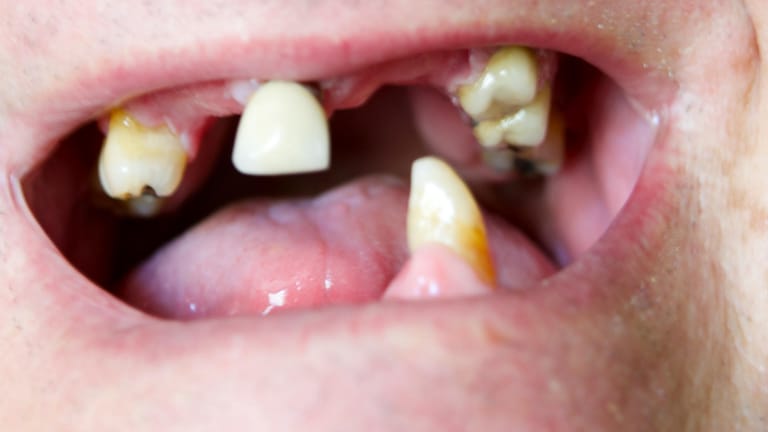 Schlechte Zähne lassen auch auf einen schlechten allgemeinen Gesundheitszustand schließen