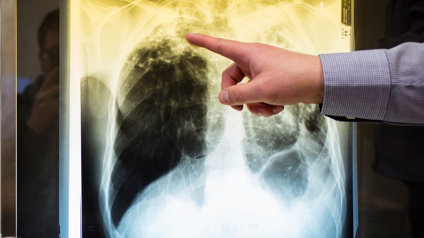 Ein Arzt zeigt einen Tuberkulosefall anhand eines Röntgenbildes.