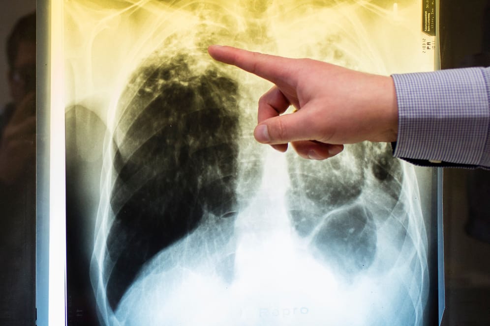 Ein Arzt zeigt einen Tuberkulosefall anhand eines Röntgenbildes.