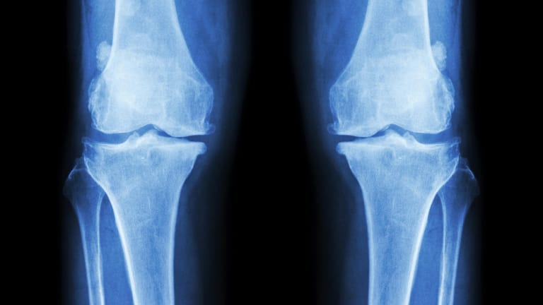 Ein Röntgenbild mit Osteoporose in beiden Knien