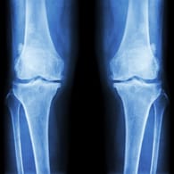 Ein Röntgenbild mit Osteoporose in beiden Knien