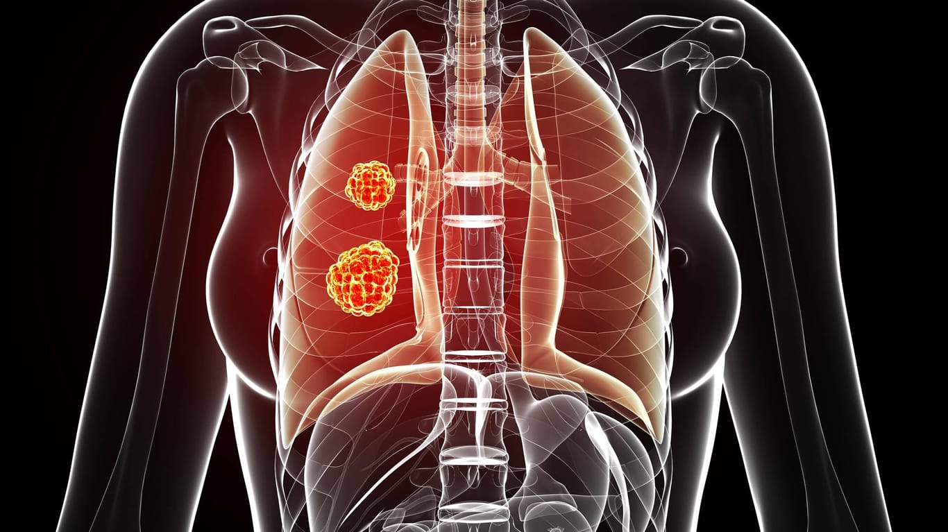 Das sind die größten Risikofaktoren für Lungenkrebs