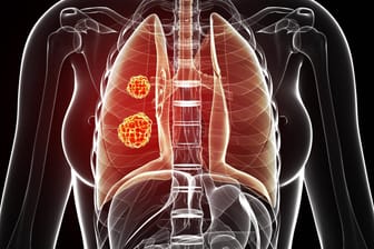 Das sind die größten Risikofaktoren für Lungenkrebs