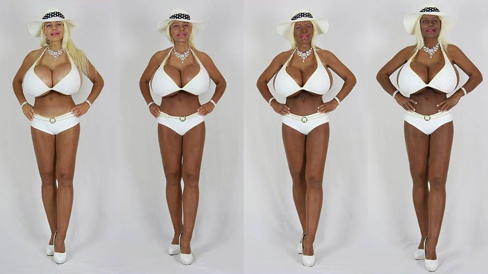 Martina Big während ihrer Behandlungen mit Melanin-Injektionen.