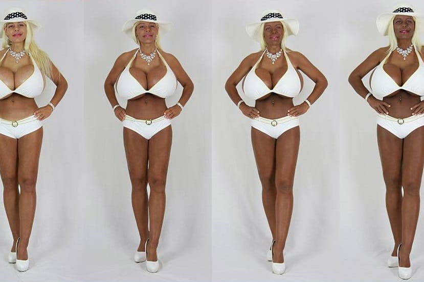 Martina Big während ihrer Behandlungen mit Melanin-Injektionen.