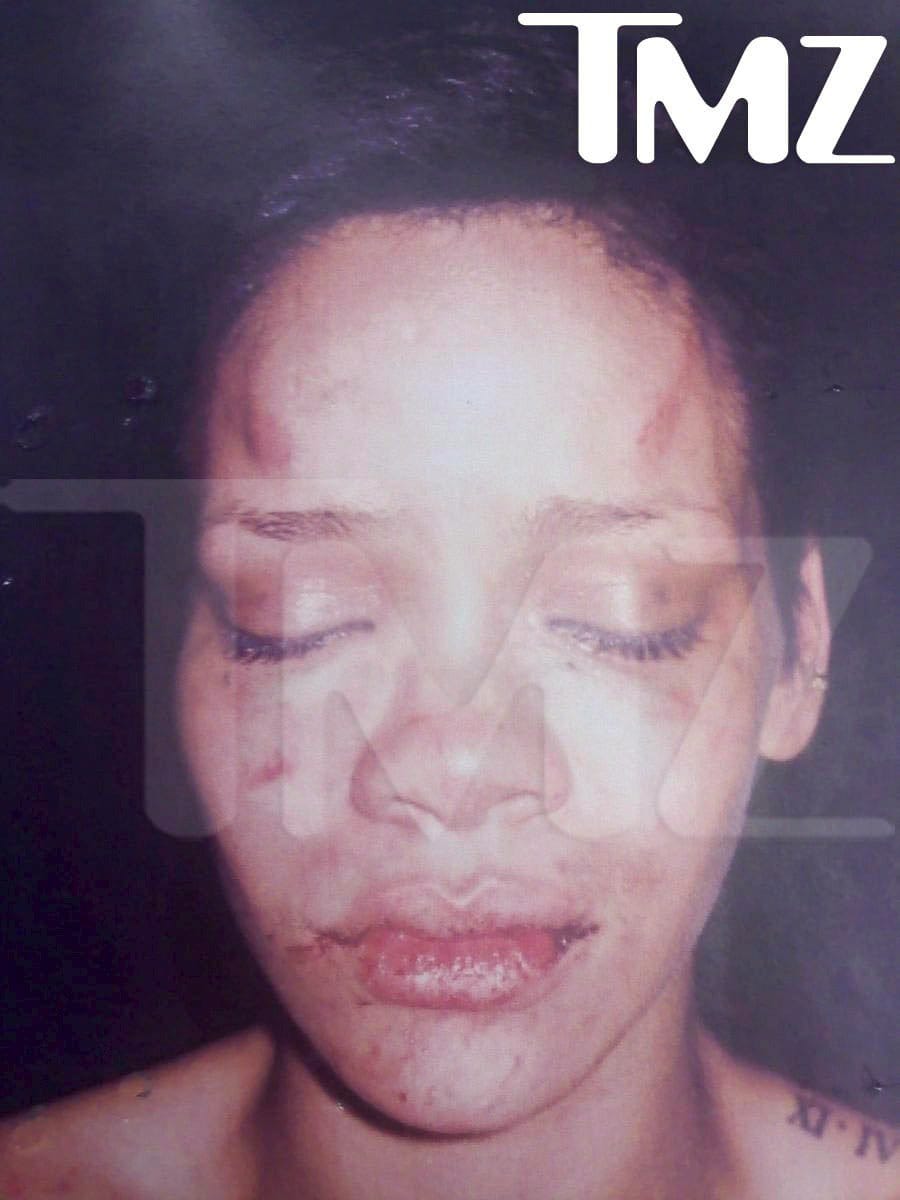 So übel zugerichtet sah Rihanna nach der Prügelattacke ihres damaligen Freundes Chris Brown im Februar 2009 aus.
