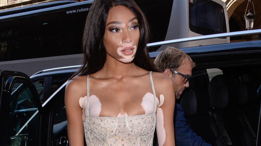 Winnie Harlow leidet an einer Hautkrankheit.