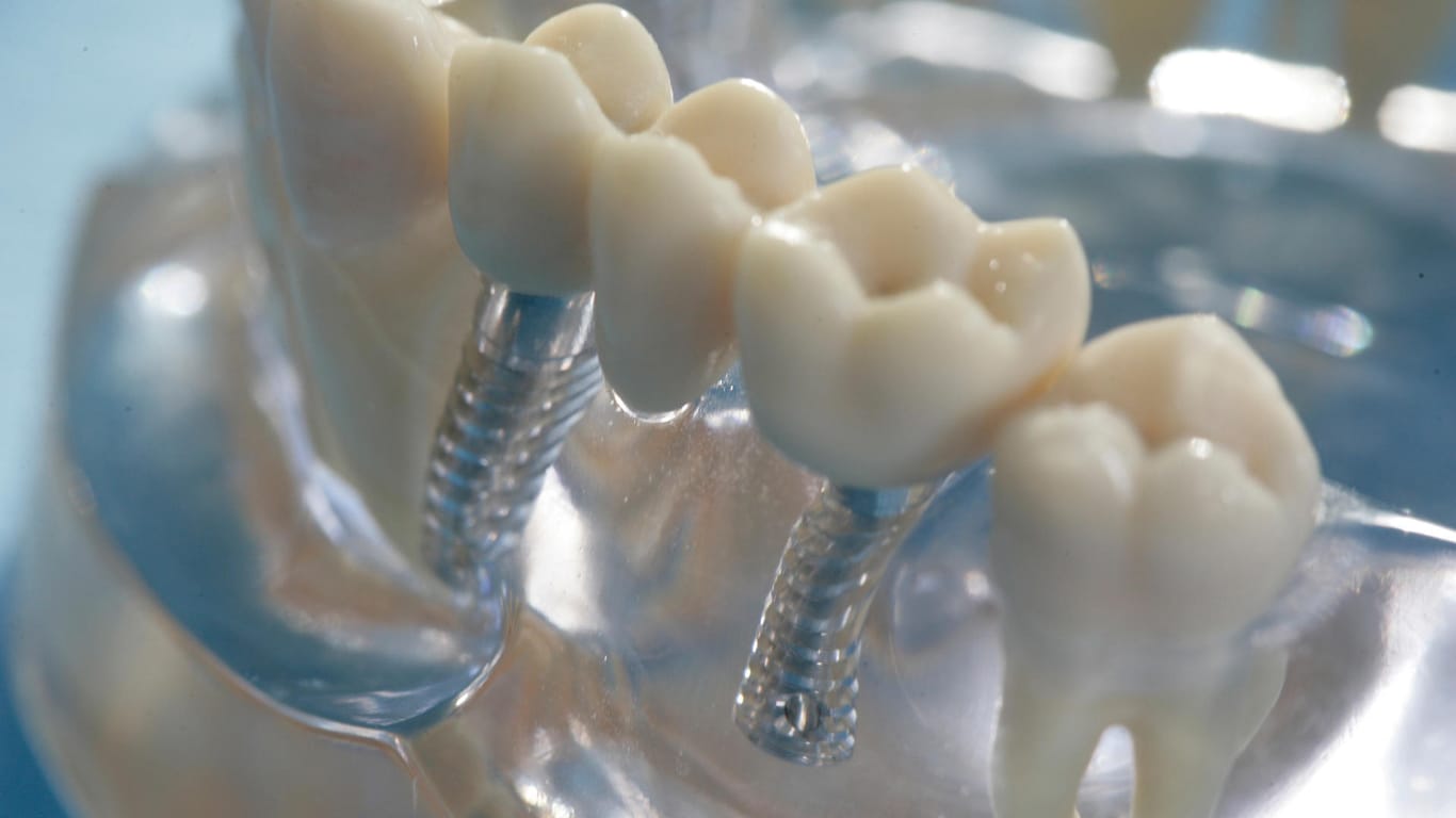 Gut beraten lassen: Zahnimplantate sind nicht für jeden geeignet