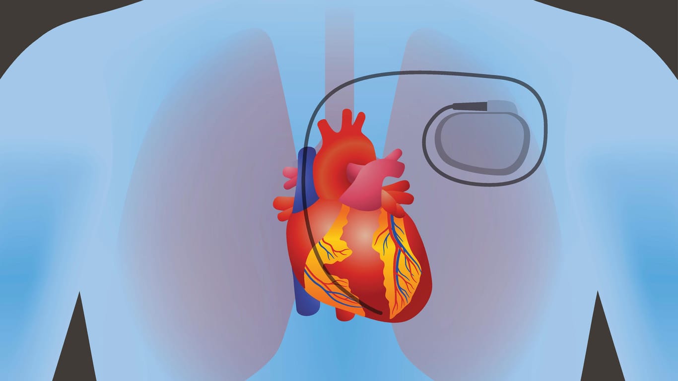 Herzschrittmacher mit Funkschnittstelle können ein Sicherheitsrisiko sein. Eine US-Firma ruft nun hunderttausende Geräte zurück.