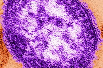Das Bild zeigt Teile des Masernvirus mit Hilfe eines Transmissionselektronenmikroskops. Zahl der Masern-Infektionen steigt.