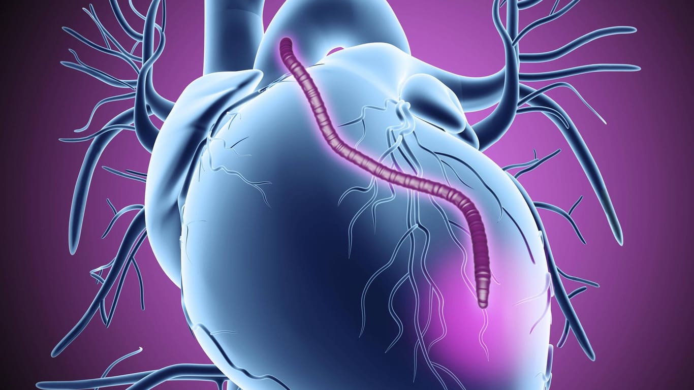 Bypass im Herzen: Bei Verengung der Herzkranzgefäße kann man mittels Bypass eine ausreichende Blutversorgung des Herzmuskels wiederherstellen.