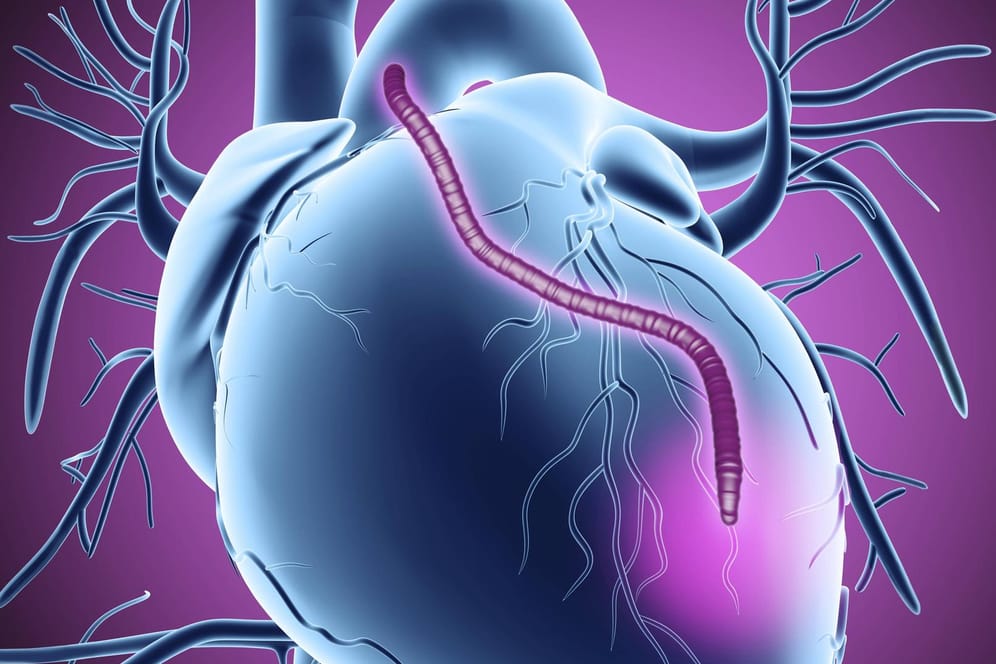 Bypass im Herzen: Bei Verengung der Herzkranzgefäße kann man mittels Bypass eine ausreichende Blutversorgung des Herzmuskels wiederherstellen.