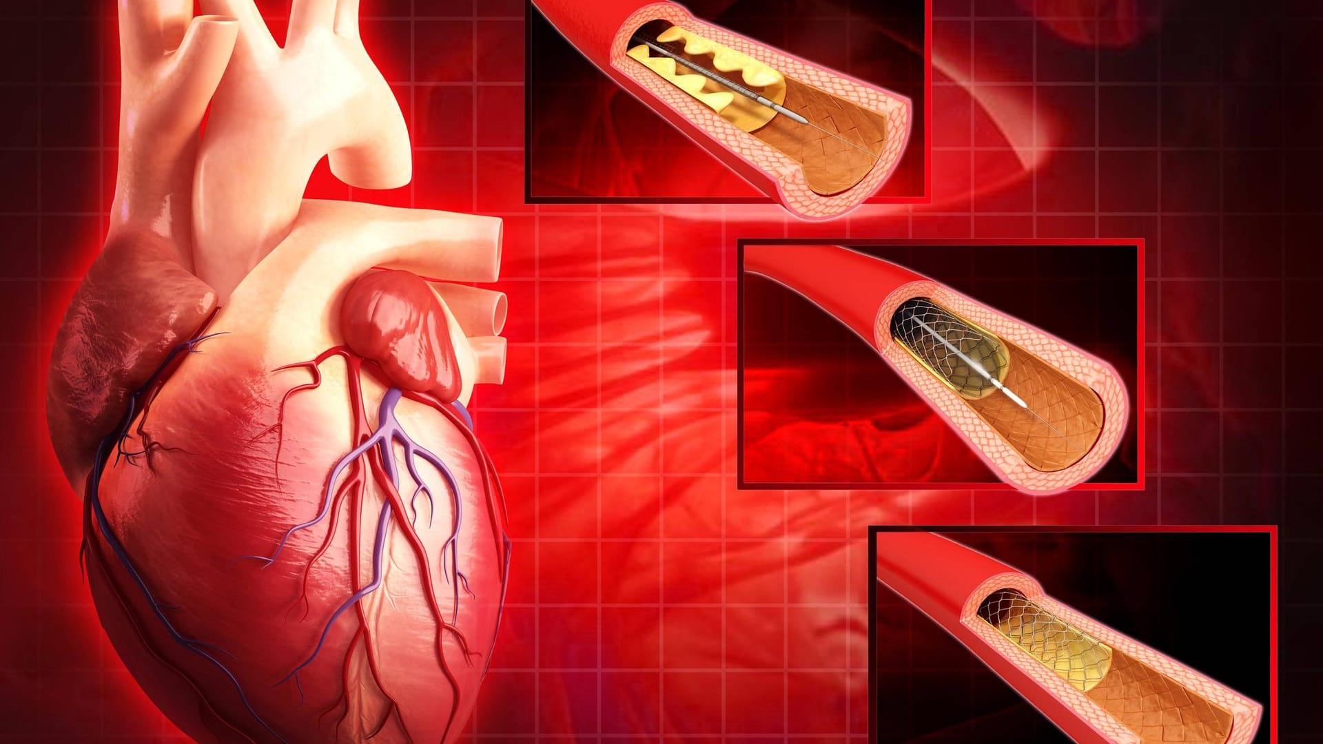 Stent: Diese Methode der Gefäßstütze stellt die Blutversorgung wieder her.