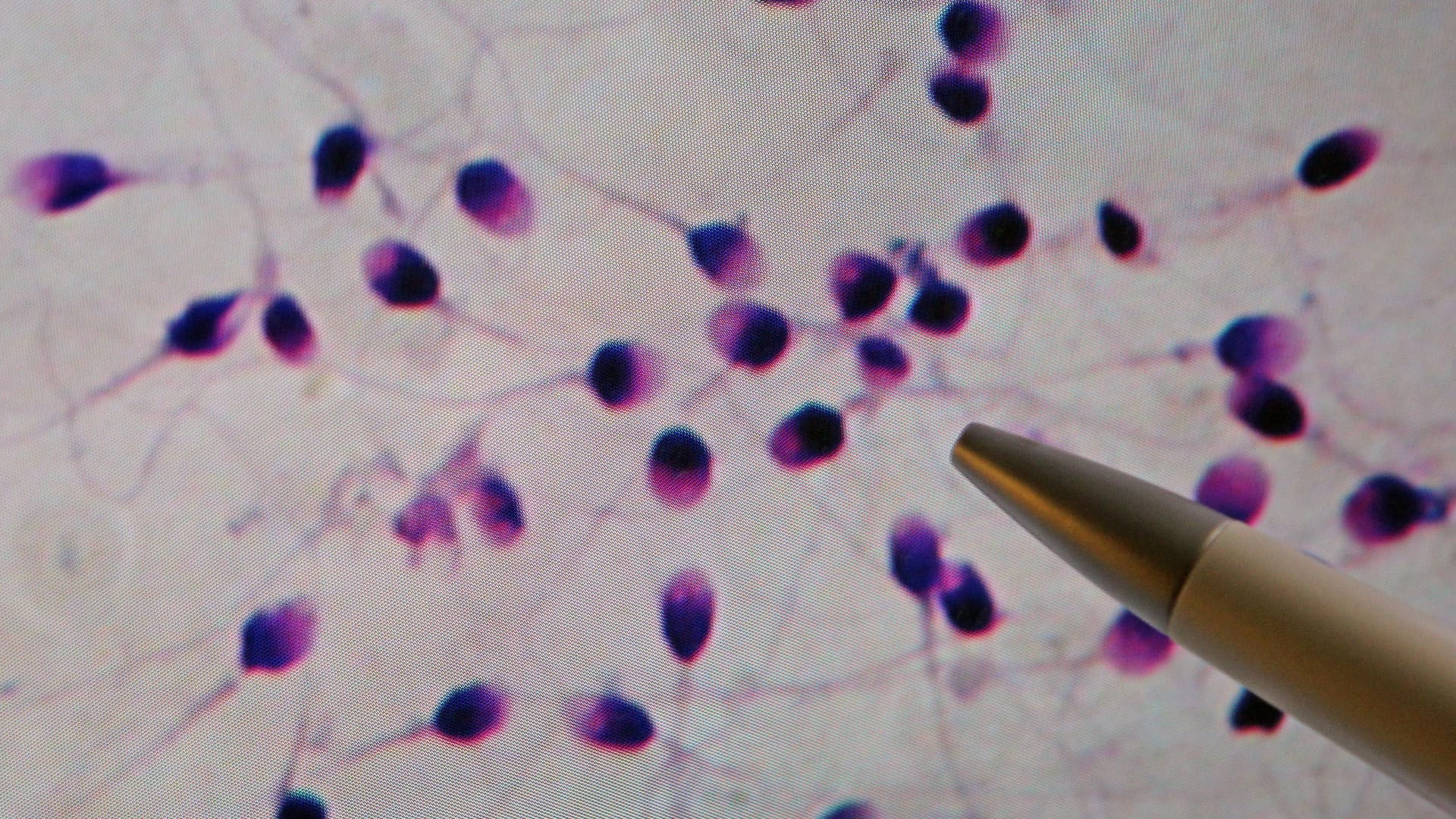 Das Spermiogramm dient zur Beurteilung der Zeugungsfähigkeit des Mannes.