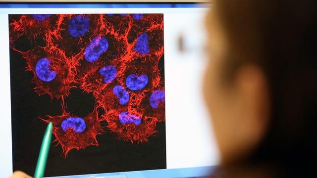 Monitorbild von Melanom-Zellen (schwarzer Hautkrebs) im Labor des Instituts für Experimentelle Gentherapie und Tumorforschung (IEGT) der Universitätsmedizin Rostock. Monitorbild von Melanom-Zellen (schwarzer Hautkrebs) im Labor des Instituts für Experimentelle Gentherapie und Tumorforschung (IEGT) der Universitätsmedizin Rostock.