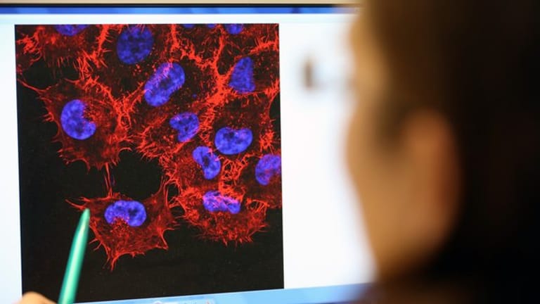 Monitorbild von Melanom-Zellen (schwarzer Hautkrebs) im Labor des Instituts für Experimentelle Gentherapie und Tumorforschung (IEGT) der Universitätsmedizin Rostock.