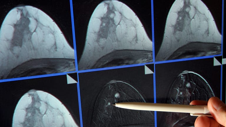 Bildschirmdarstellung einer Magnetresonanz-Mammographie: Hier ist ein winziger Tumor in der Brust einer Patientin zu sehen.