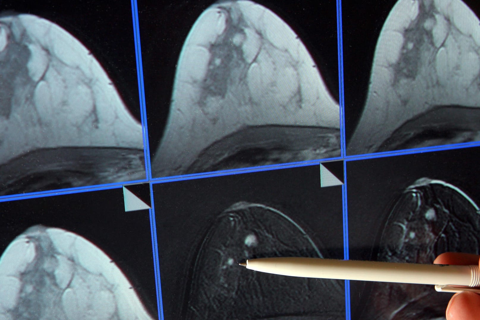 Bildschirmdarstellung einer Magnetresonanz-Mammographie: Hier ist ein winziger Tumor in der Brust einer Patientin zu sehen.