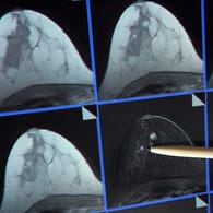 Bildschirmdarstellung einer Magnetresonanz-Mammographie: Hier ist ein winziger Tumor in der Brust einer Patientin zu sehen.