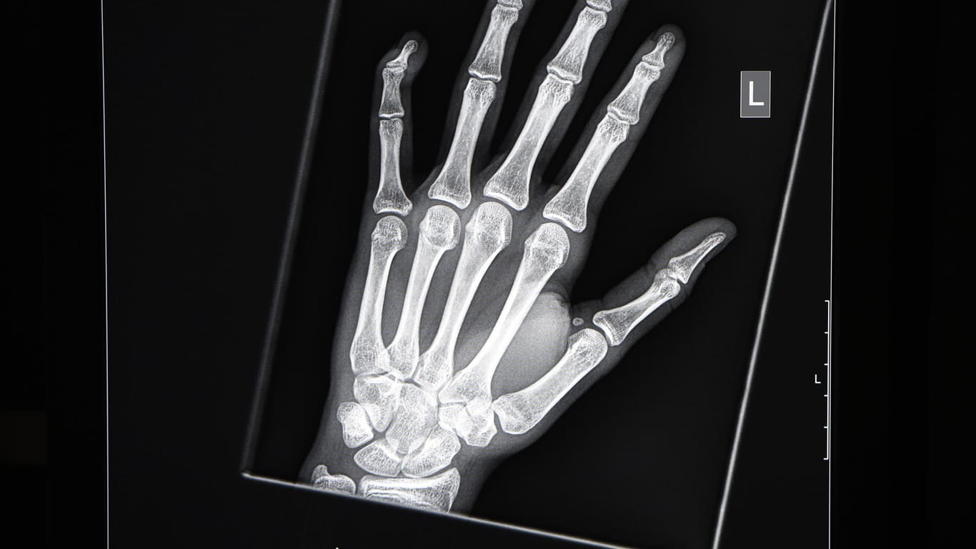Röntgenbild einer jugendlichen Hand: Darf der Staat aus Generalverdacht röntgen? Nein, sagt der Präsident der Bundesärztekammer.