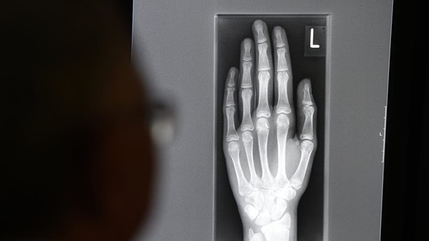 Ein Röntgenbild mit der linken Hand eines jungen Menschen im Alter zwischen 16 und 19 Jahren.