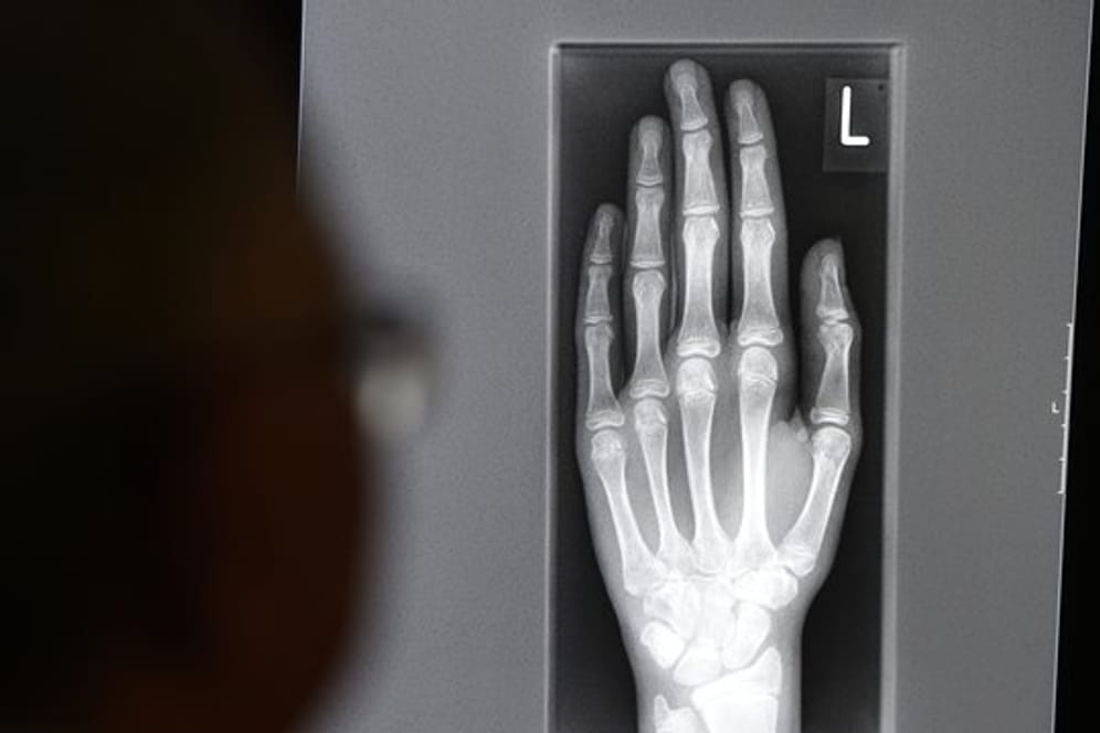 Ein Röntgenbild mit der linken Hand eines jungen Menschen im Alter zwischen 16 und 19 Jahren.