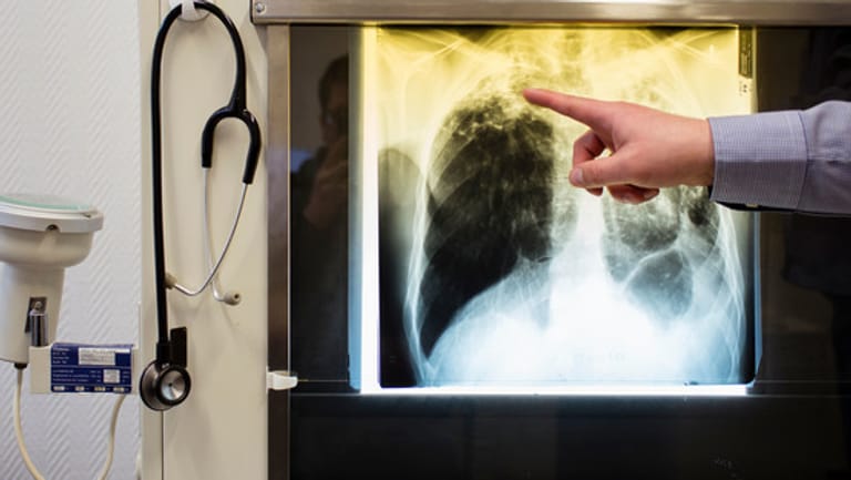 Ein Tuberkulose-Fall auf einem Röntgenbild: Wissenschaftler haben einen europaweiten Ausbruch eines multiresistenten Erregers entdeckt und eingedämmt.