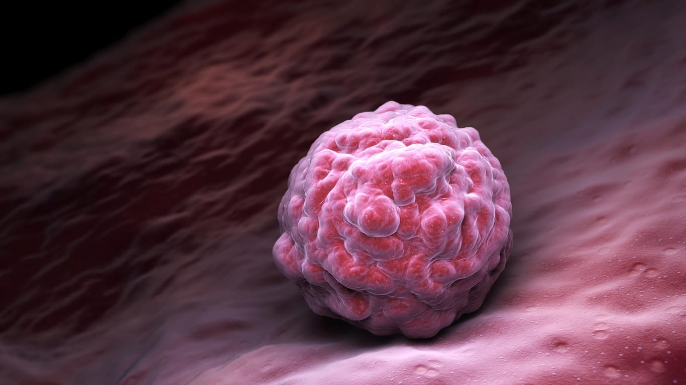 Embryonale Stammzelle: Teratome bilden sich aus Stammzellen des Embryonalgewebes.