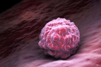 Embryonale Stammzelle: Teratome bilden sich aus Stammzellen des Embryonalgewebes.