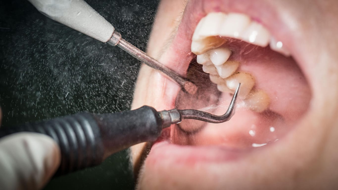Professionellen Zahnreinigung: Eine Zahnreinigung kostet bis zu 150 Euro und gilt als eine nicht medizinisch notwendige Privatleistung.