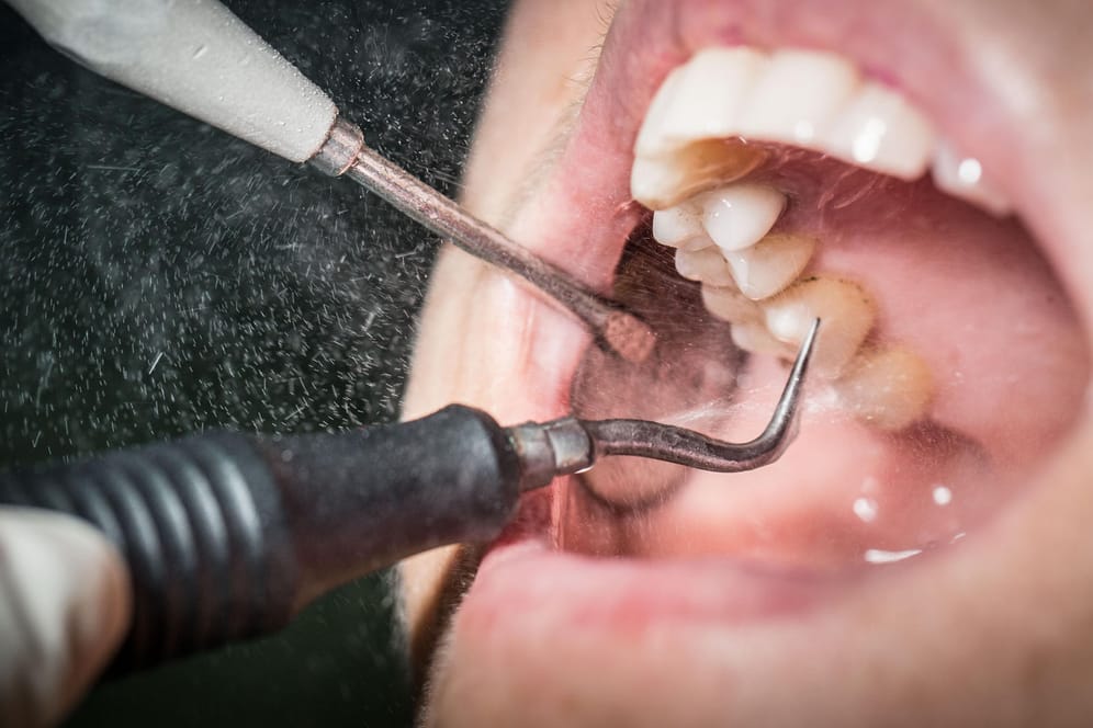 Professionellen Zahnreinigung: Eine Zahnreinigung kostet bis zu 150 Euro und gilt als eine nicht medizinisch notwendige Privatleistung.