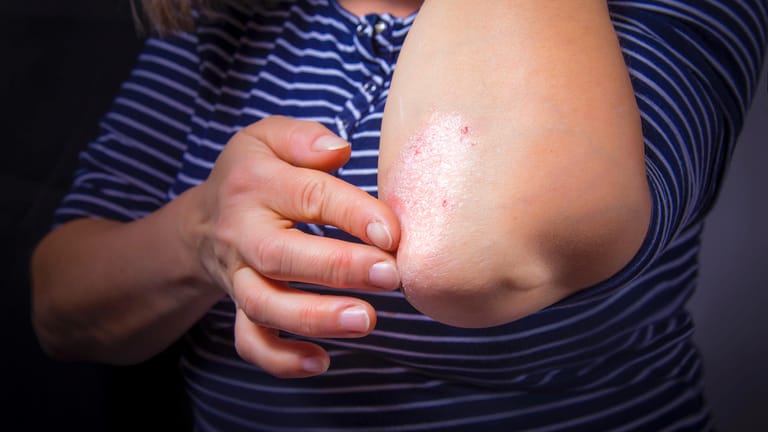 Schuppenflechte am Ellenbogen: Bei Menschen, die an Psoriasis Arthritis erkranken, reagiert zuerst die Haut. Sie zeigt meist rundliche Flecken, die silbrige Schuppen aufweisen.