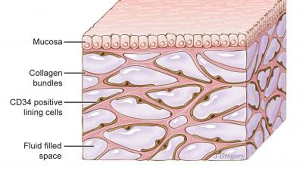 Das Interstitium unter der oberen Hautschicht: Mediziner haben im Körper ein Netzwerk entdeckt, das den Organismus durchzieht und möglicherweise an der Ausbreitung von Krebs beteiligt ist.