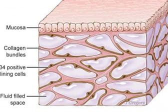 Das Interstitium unter der oberen Hautschicht: Mediziner haben im Körper ein Netzwerk entdeckt, das den Organismus durchzieht und möglicherweise an der Ausbreitung von Krebs beteiligt ist.