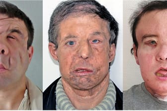 Ein 43-Jähriger Franzose mit seinen drei Gesichtern: Nach seiner zweiten Gesichtstransplantation scherzt der 43-Jährige Patient: "Ich bin 43. Der Spender war 22. Ich bin also 20 Jahre jünger geworden."