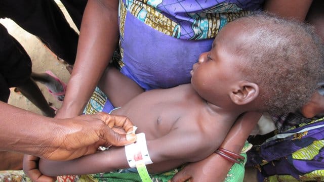 Ein Baby wird gewogen und vermessen, um den Grad seiner Unterernährung zu ermitteln. Ein Baby wird gewogen und vermessen, um den Grad seiner Unterernährung zu ermitteln.