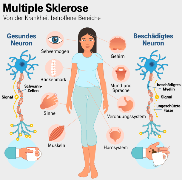 Bei Multipler Sklerose wird die Schicht, von der Nervenbahnen schützend umgeben sind – die Myelinscheiden – zerstört.