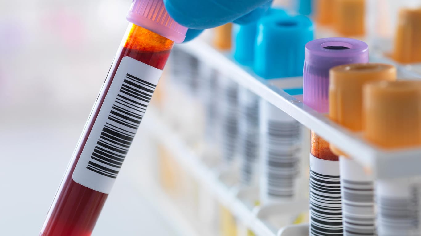 Blutproben für einen HIV-Test: Die Suche nach einem Impfstoff gegen Aids ist herausfordernd, weil das HI-Virus sehr anpassungsfähig ist.