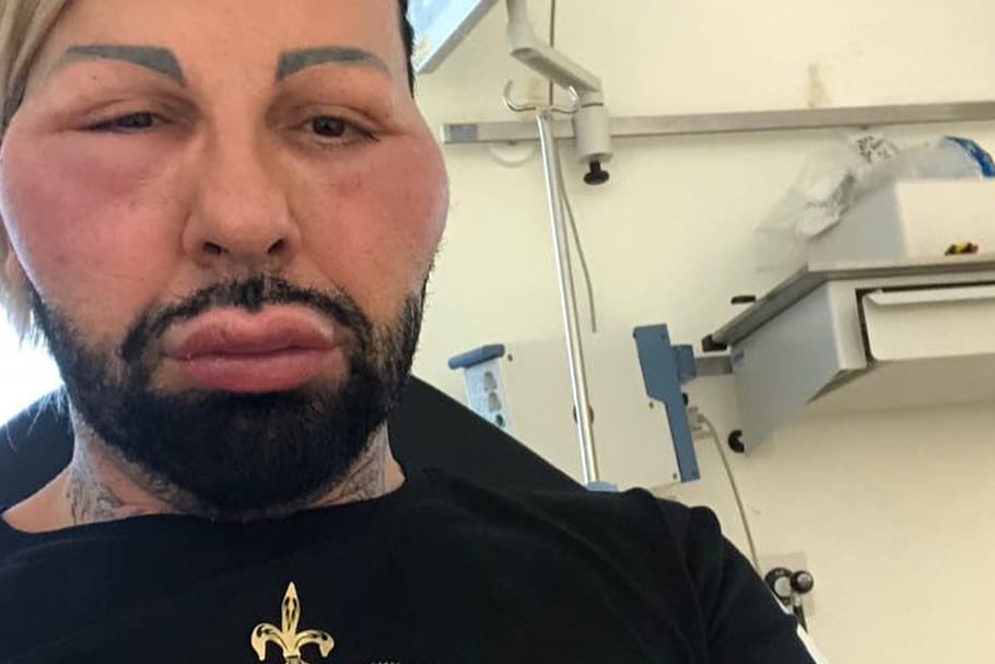 Harald Glööckler: Nach einem allergischen Schock musste er ins Krankenhaus.