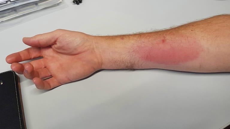 Bremsenstich an einem Arm: Gehen Sie bei starken Reaktionen auf einen Stich zum Arzt.