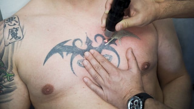 Ein Arzt entfernt ein Tattoo per Laser.