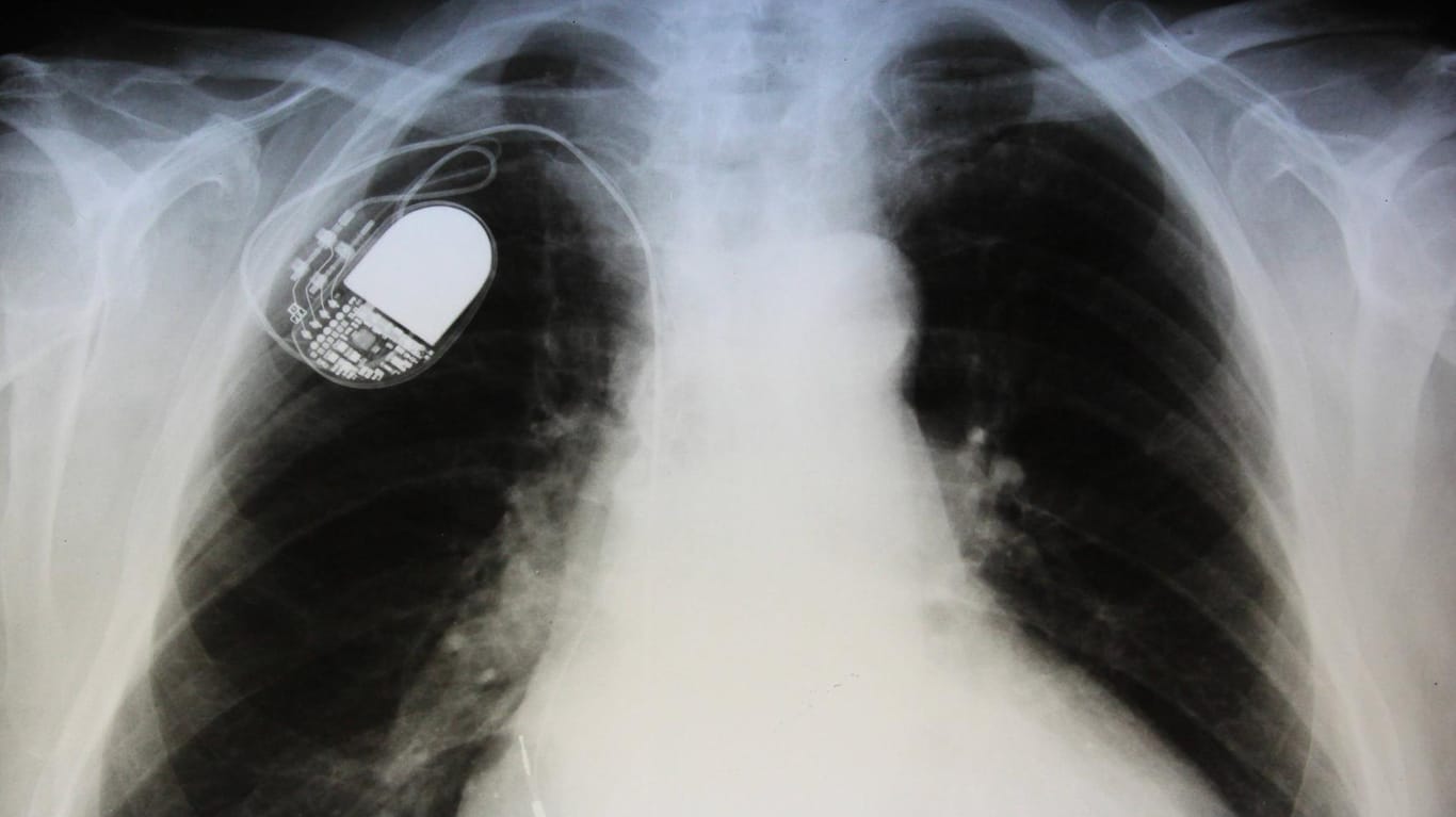 Herzschrittmacher in der Röntgenaufnahme: Manipulationen sind möglich.