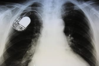 Herzschrittmacher in der Röntgenaufnahme: Manipulationen sind möglich.
