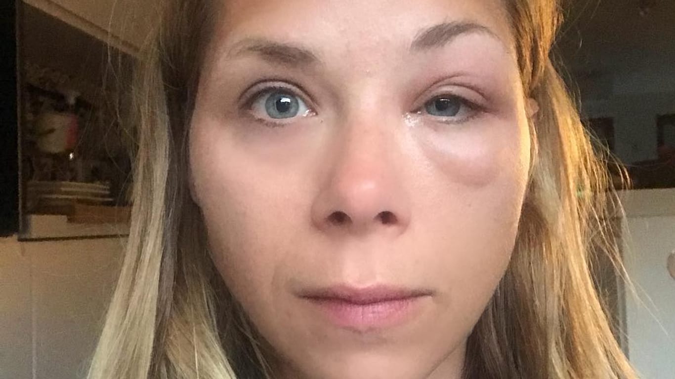 Tanja Szewczenko: Die Schauspielerin wurde von einer Wespe gestochen.