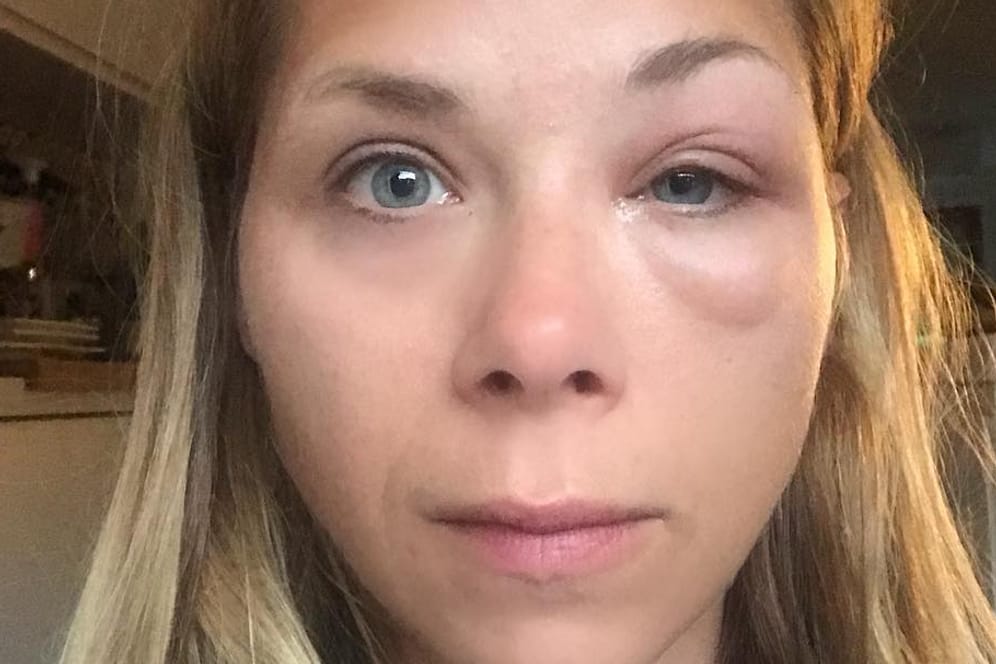Tanja Szewczenko: Die Schauspielerin wurde von einer Wespe gestochen.