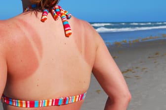 Eine Frau mit Sonnenbrand: Schon sehr niedrige Dosen UV-Strahlung verursachen Veränderungen des Erbguts in der Haut, die das Krebsrisiko vergrößern können.